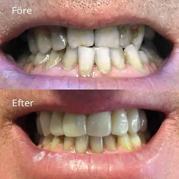 Tandreglering - Specialister på tandreglering före och efteråt - Västra Frölunda tandläkarna