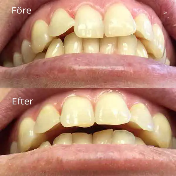 Tandreglering Göteborg med före och efter bild | Frölunda tandläkarna är specialister på tandreglering
